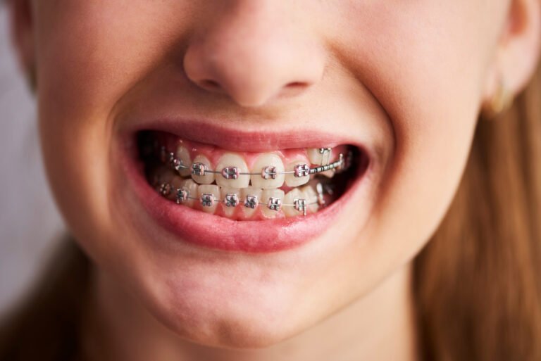 Are braces necessary, and when should they be considered?